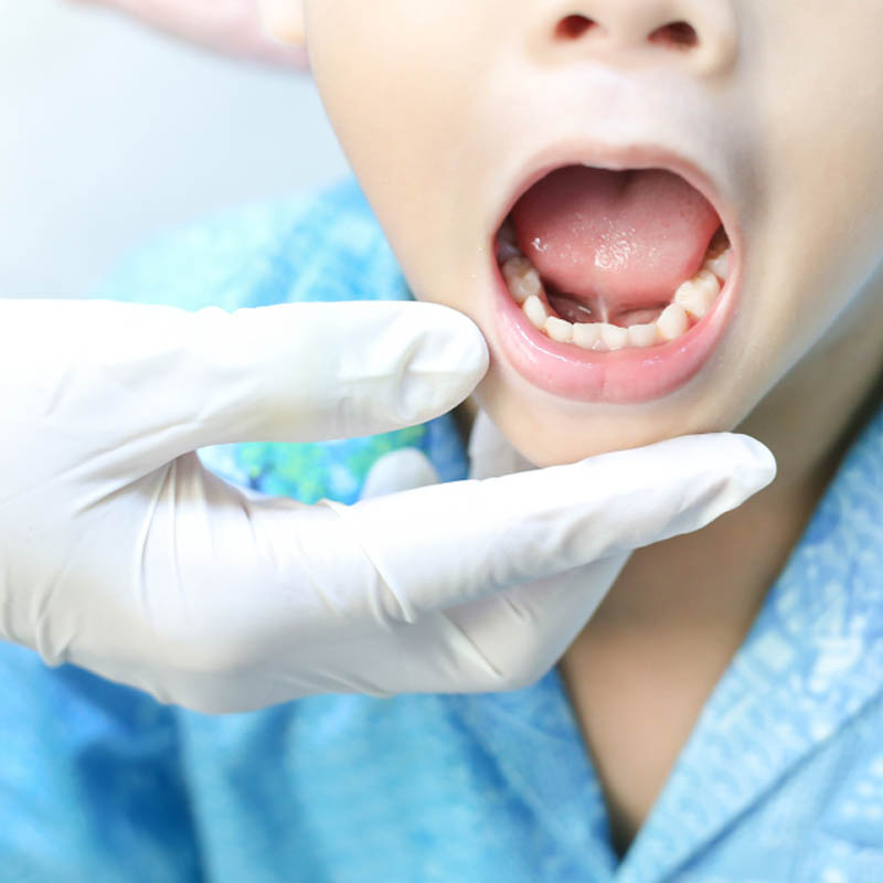 Tongue Ties and Lip Ties